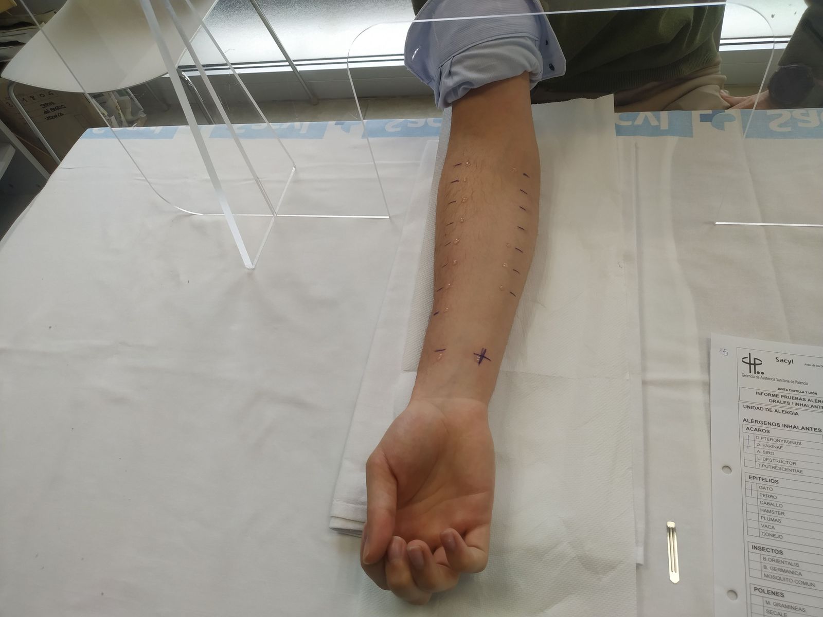 Realización de pruebas de alergia ICAL