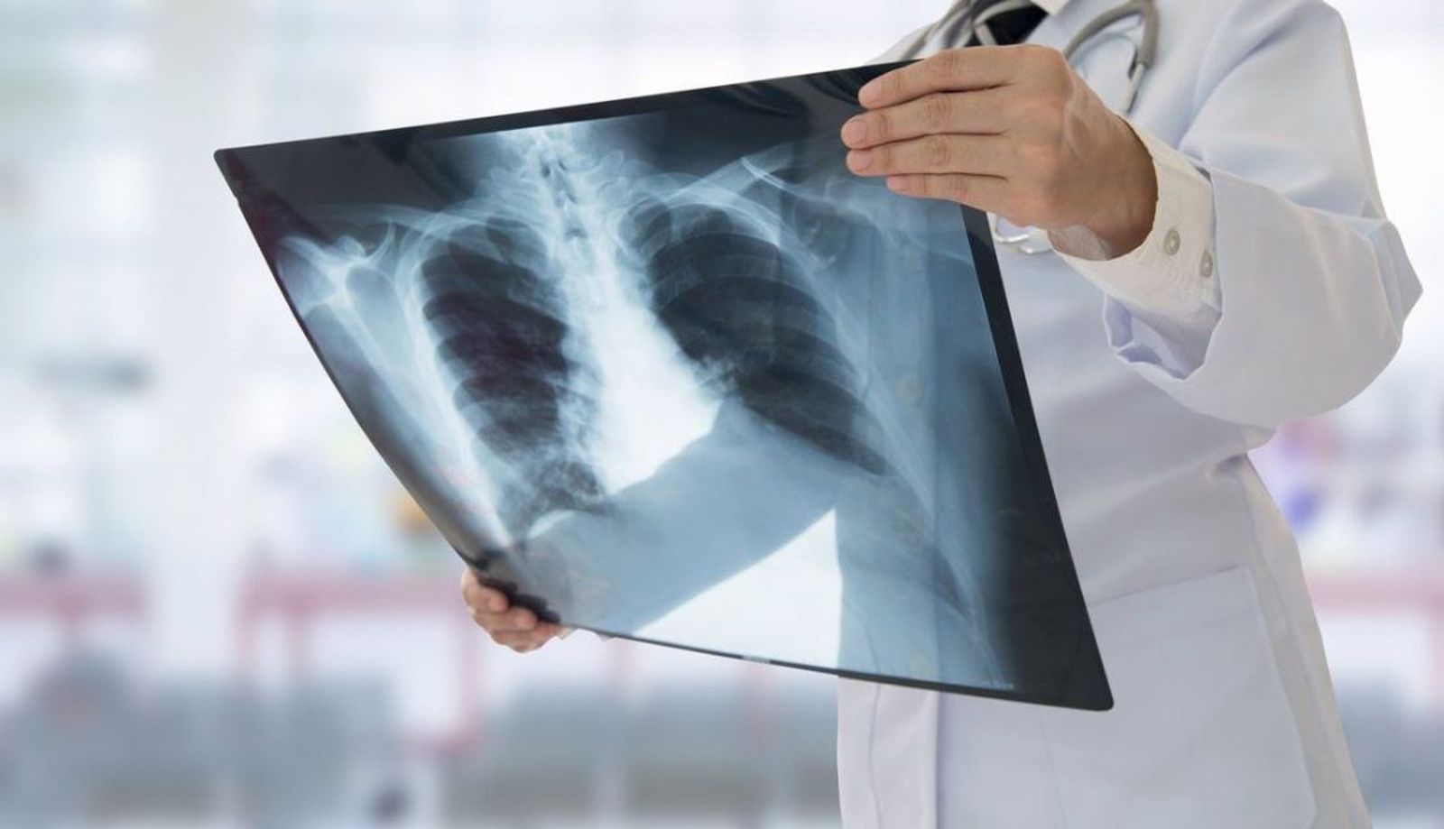 Cáncer de pulmón   EP